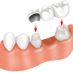 Dental_Bridge-150×150