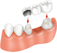 Dental_Bridge