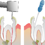 Root_Canal_Illustration_Molar_0-150×150