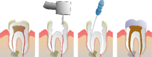 Root_Canal_Illustration_Molar_0-300×114