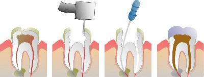 Root_Canal_Illustration_Molar_0