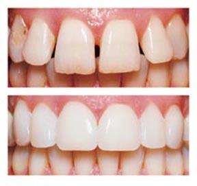 Veneers-bef