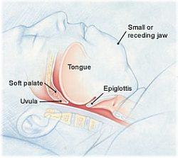 blocked_airway