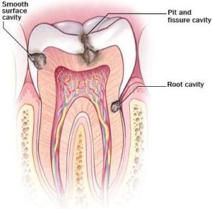 cavities-300×296