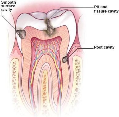 cavities