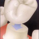 dental_crown_diagram-150×150