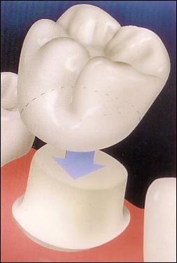 dental_crown_diagram_0