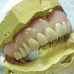 dentures-150×150