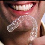 invisalign-questions-150×150