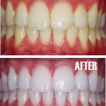 teeth-whitening-cost-150×150