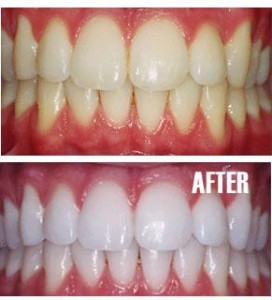 teeth-whitening-cost-272×300