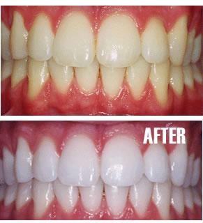 teeth-whitening-cost