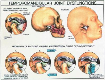 tmj-dysfunctions