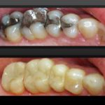 tooth-colored-fillings-150×150