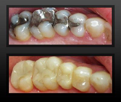 tooth-colored-fillings