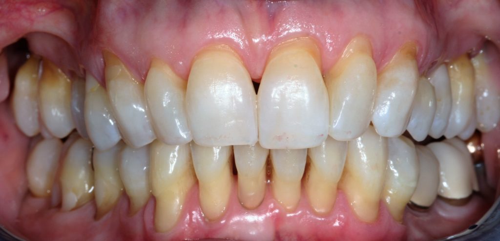 gum-recession-createsmiles-by-dr-brad-lockhart-tustin-dentist