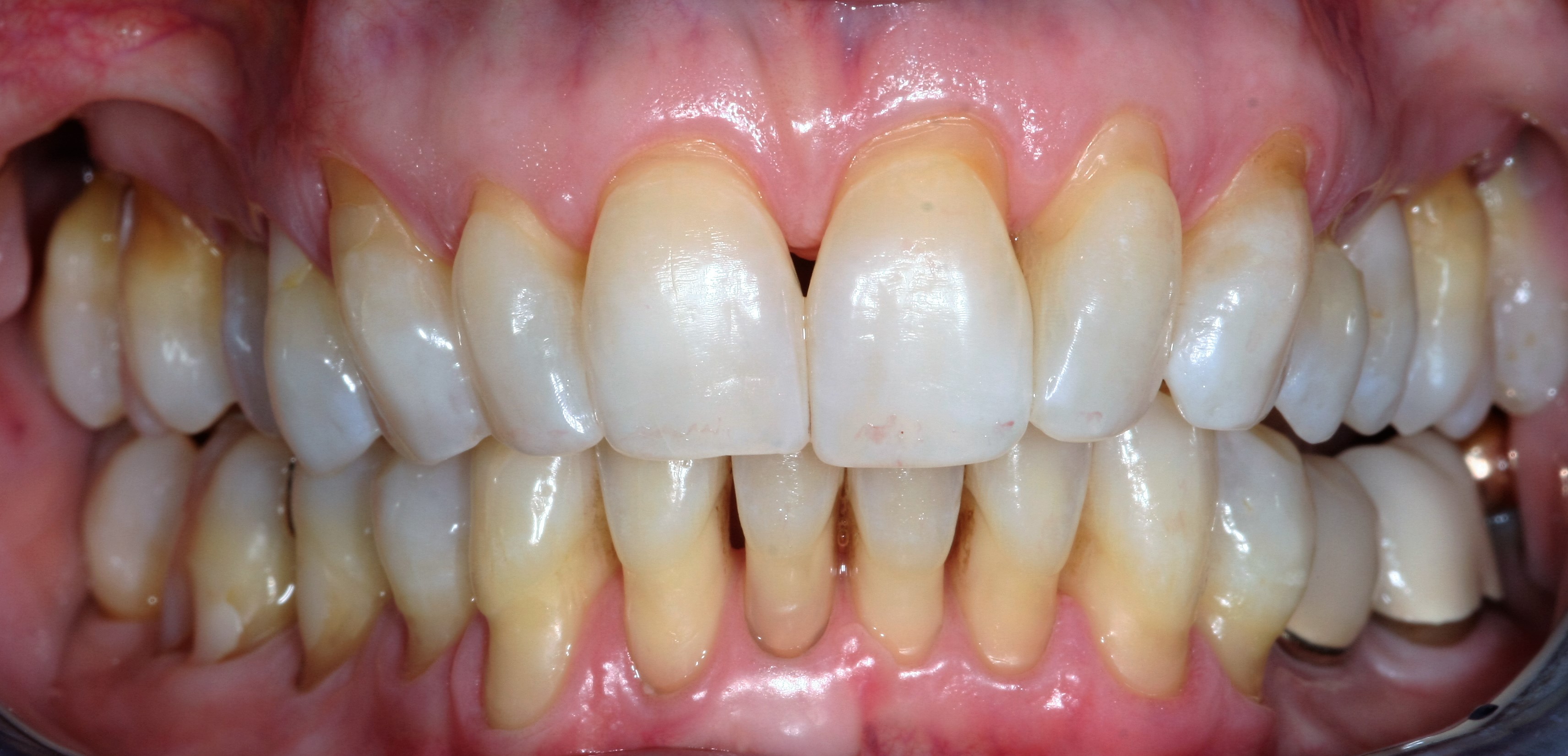 Gum-Recession - CreateSmiles by Dr. Brad Lockhart | Tustin Dentist