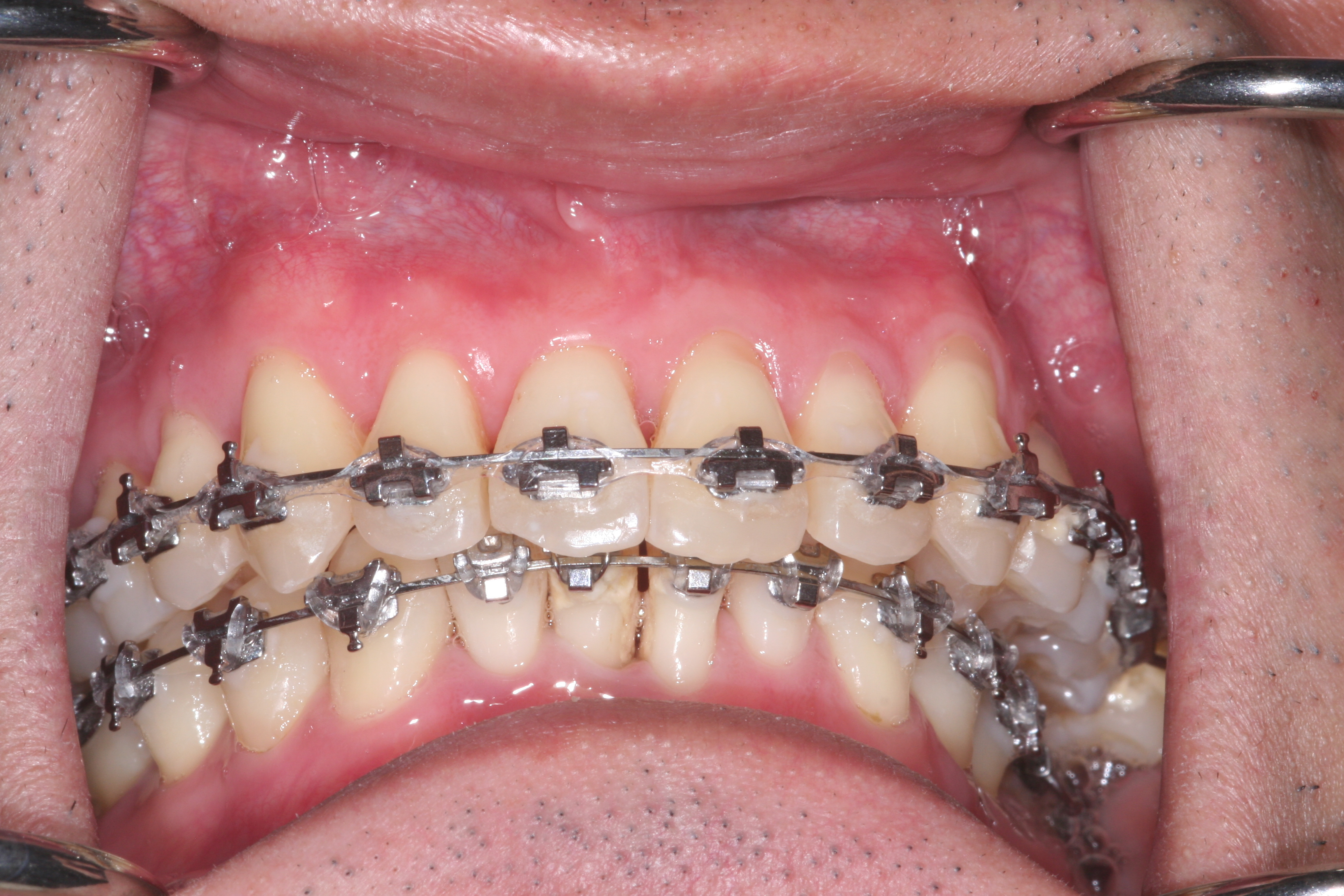 Frontal View With Braces