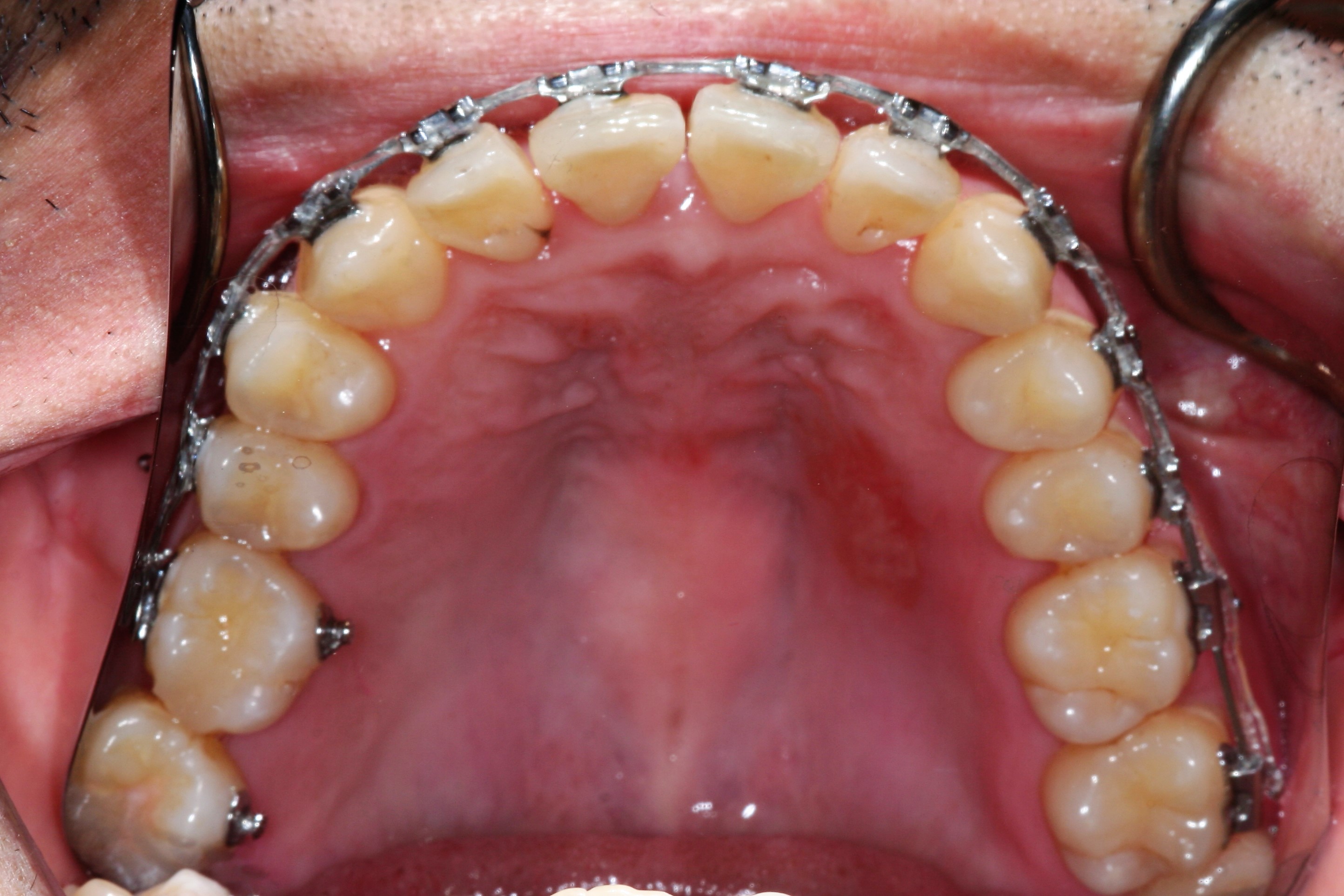 Upper Arch With Braces