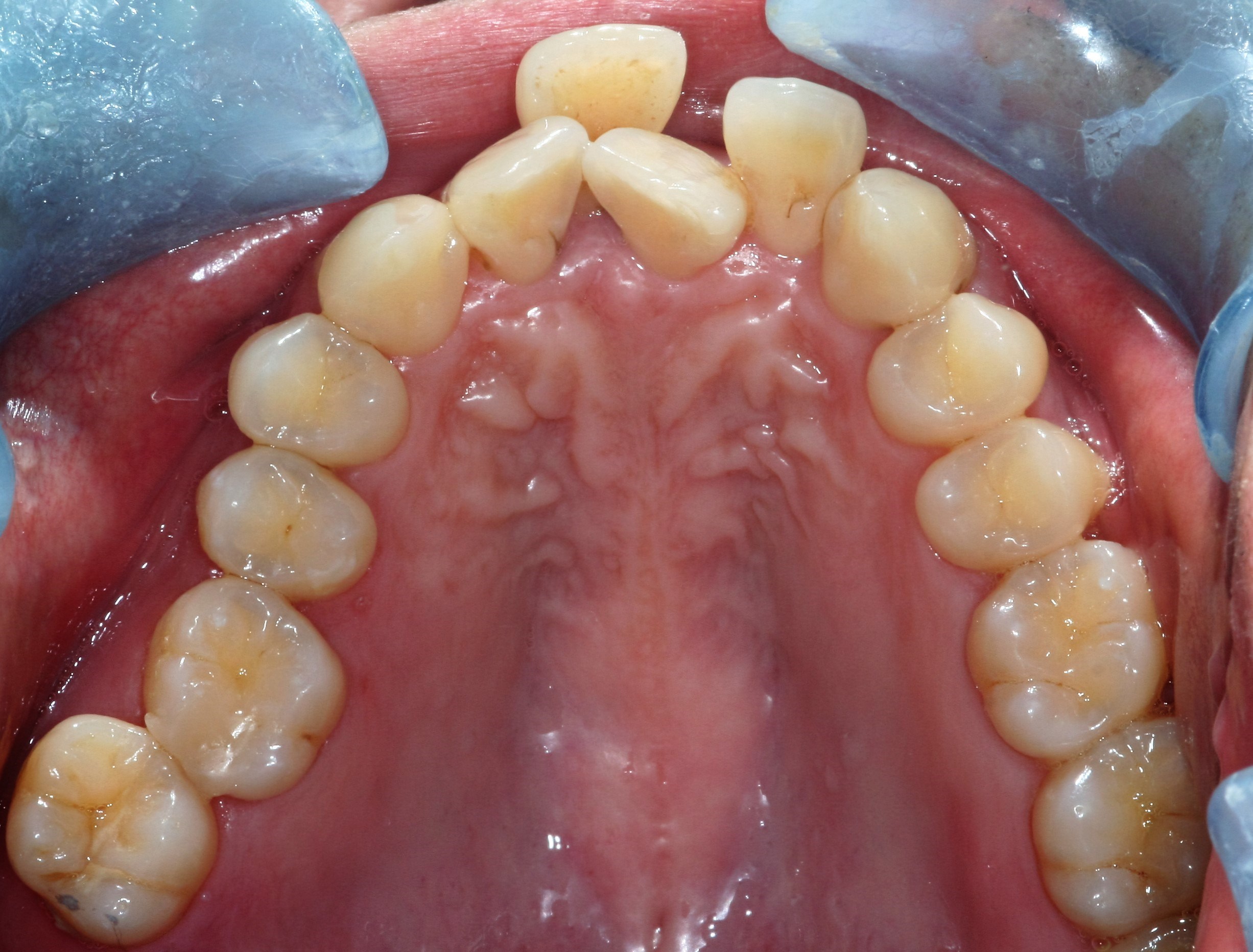 Underdeveloped-dental-arch